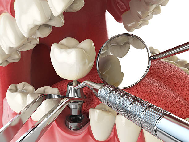 Best Emergency Dental Filling Replacement  in Villisca, IA